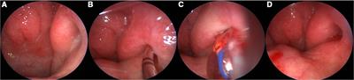 In-office Eustachian tube balloon dilation under local anesthesia as a response to operating room restrictions associated with the COVID-19 pandemic